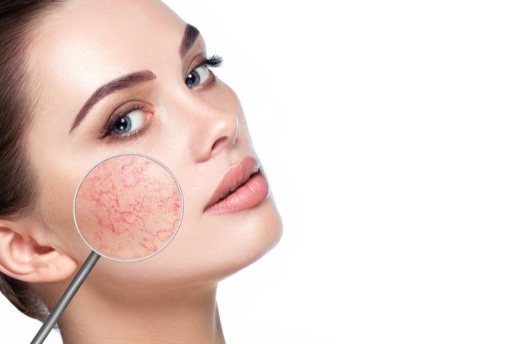 Tratamiento de Rosacea