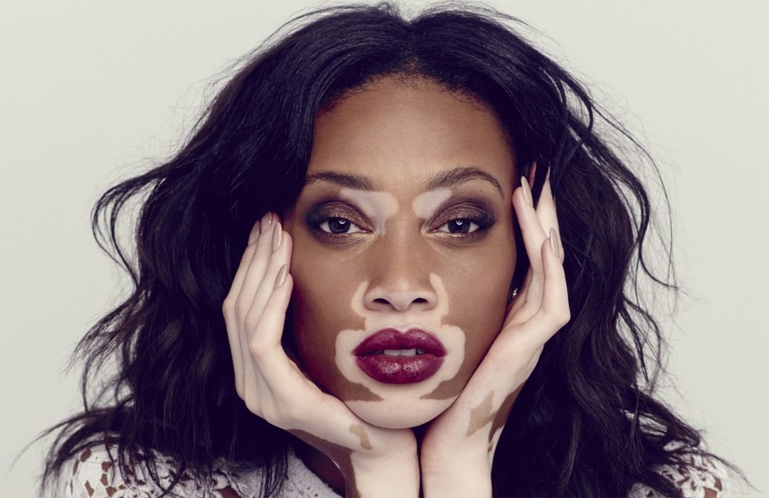 Vitiligo